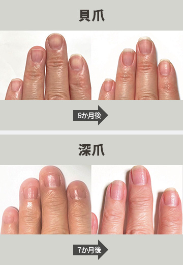 貝爪、深爪