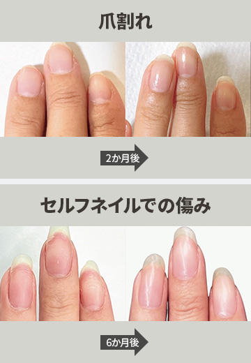 爪割れ、セルフネイルでの痛み